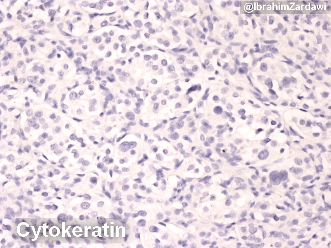 Carotid body tumour_Cytokeratin_IZ.jpg